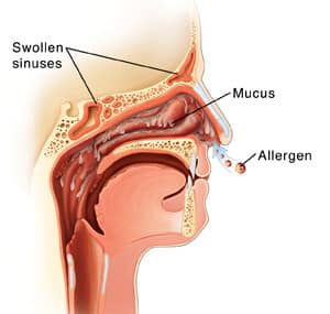 Nasal Allergy
